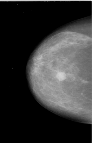 Example of a mammogram image with prominent mass
